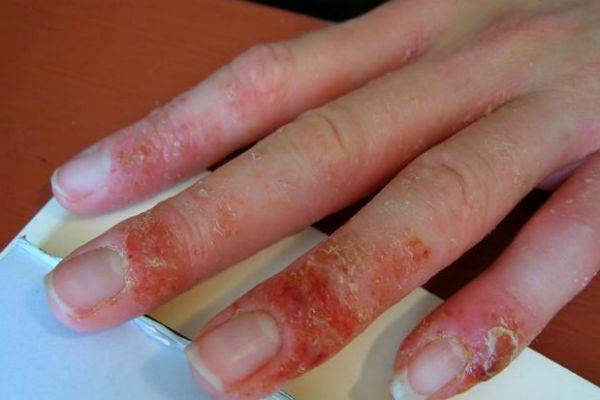 Аллергия на гель-лак. причины, симптомы, как избежать