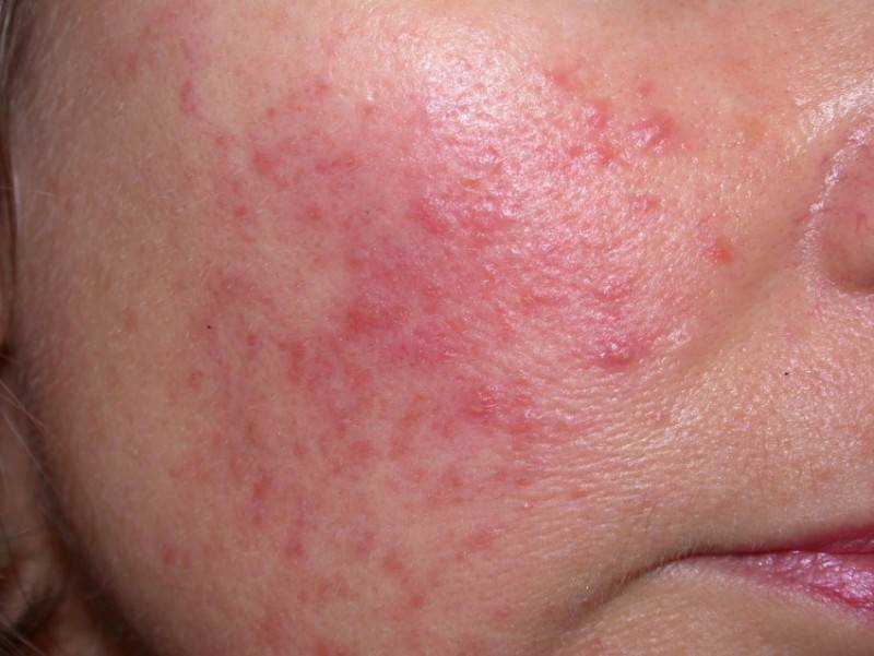 Как может проявляться аллергия на лице фото