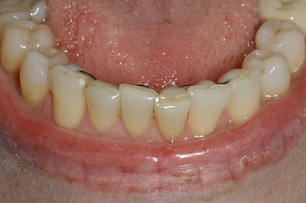 Как восстановить эмаль зубов — восстановление цвета зубного ряда