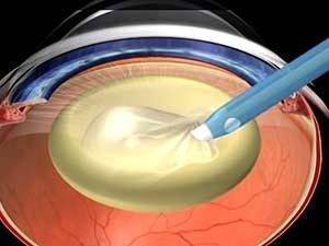 Как лечить катаракту без операции народными средствами отзывы кто вылечился