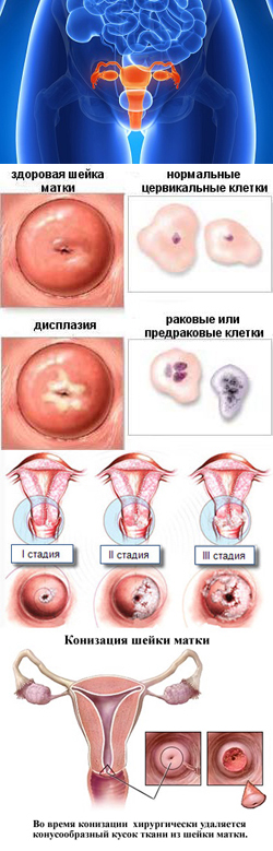 Дисплазия шейки матки: симптомы, степени – легкая, тяжелая, умеренная, лечение