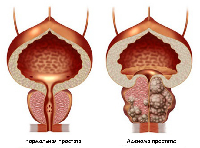 Аденома простаты (аденома предстательной железы): причины, симптомы и лечение у мужчин