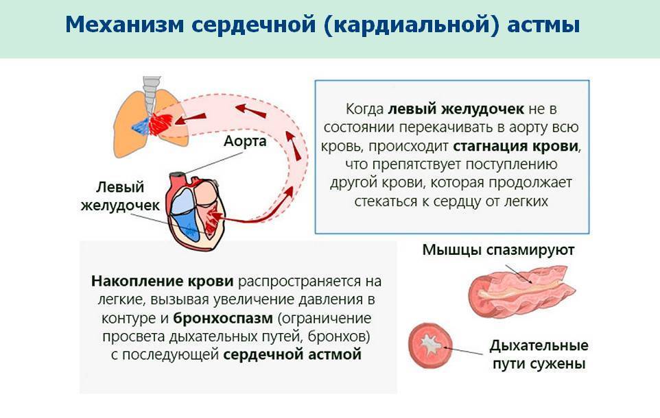 Клиническая картина сердечной астмы