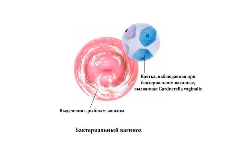 Бактериальный вагинит: причины и признаки заболевания, тактика лечения и терапия при беременности