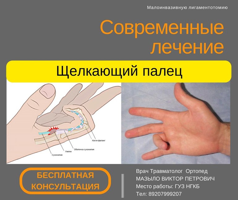 Почему болят пальцы на правой руке. Стенозирующий лигаментит. Болезнь Нотта. Стенозирующий лигаментит пальца. Стенозирующий лигаментит большого пальца кисти. Стенозирующий лигаментит 1 пальцев кистей.