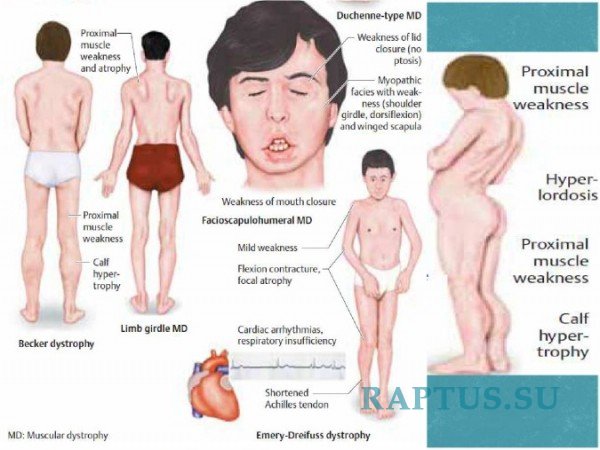 Симптомы мышечной дистрофии при разных формах заболевания