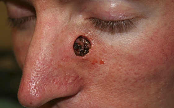 Симптомы и лечение базалиомы кожи, лица, носа