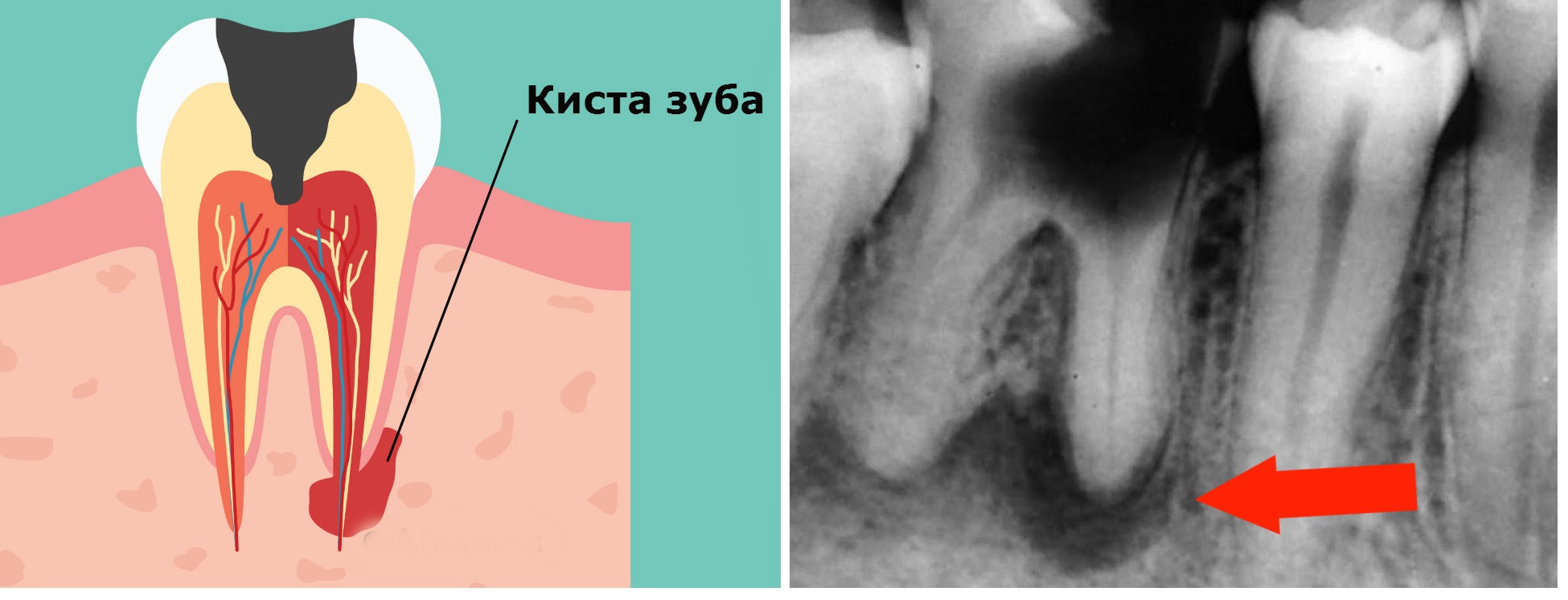 Киста в десне зуба: причины и симптомы, способы лечения
