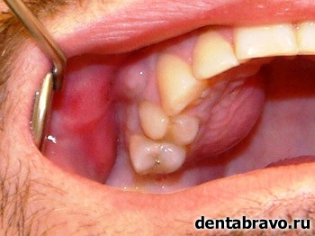 Киста на корне зуба: фото, симптомы и лечение