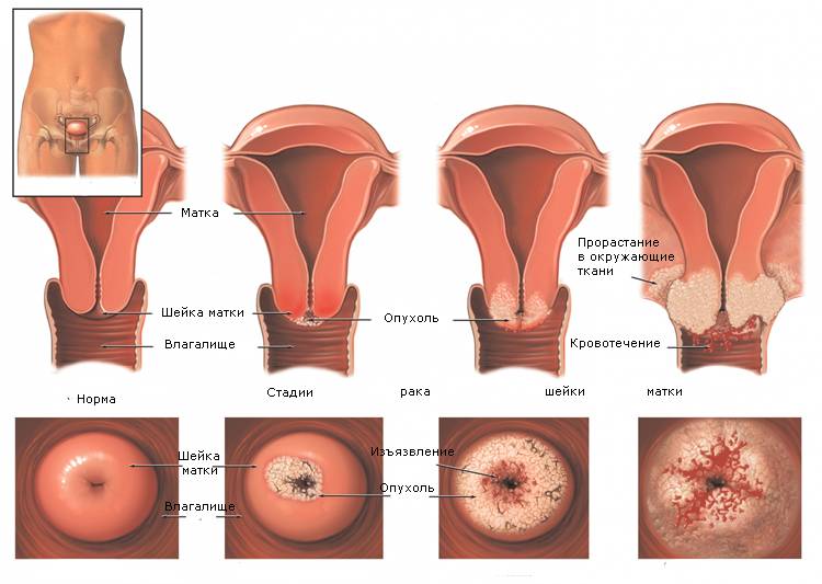 Рак шейки матки - описание болезни