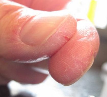 Экзема на пальцах рук – как избавиться от экземы | derma-expert.ru