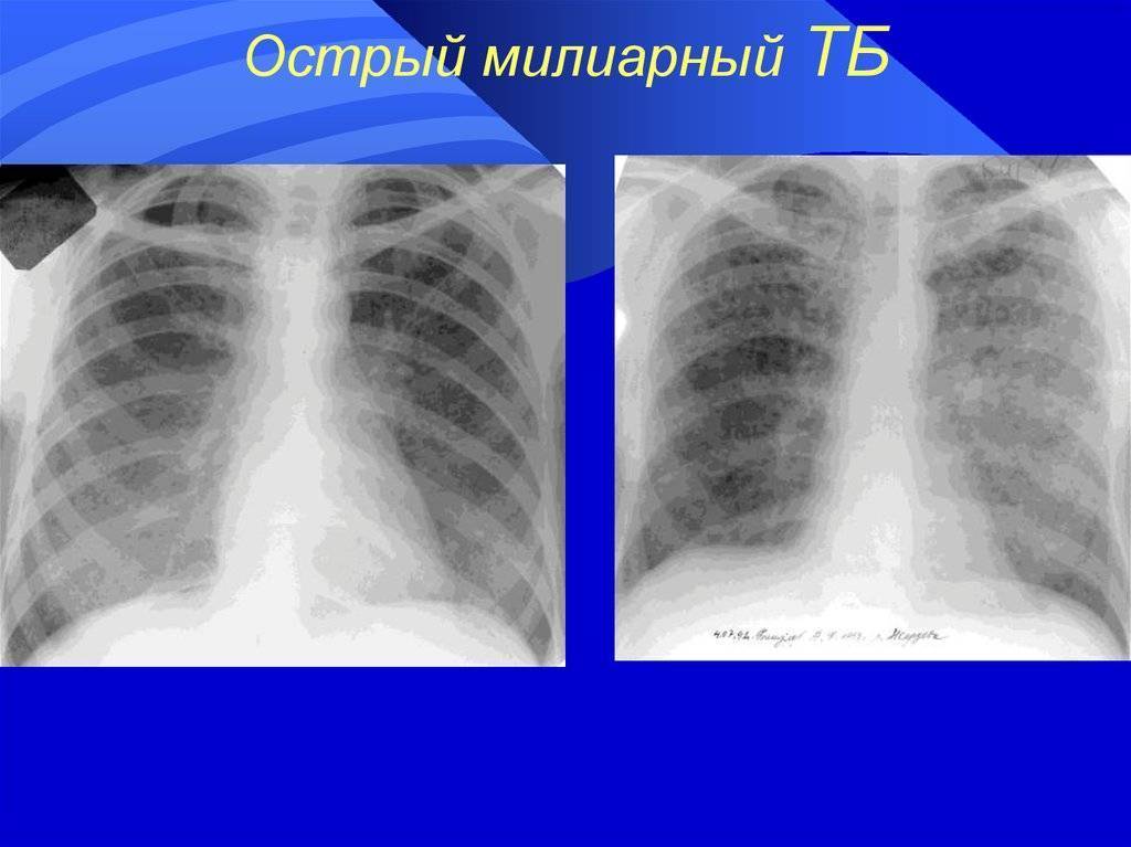 Рентгенологическая картина милиарного туберкулеза