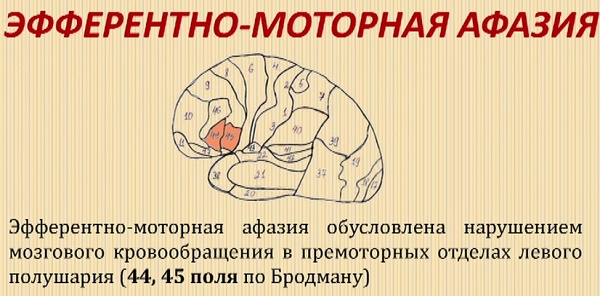 Моторная афазия у детей