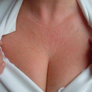 Высыпания на грудине у женщин фото