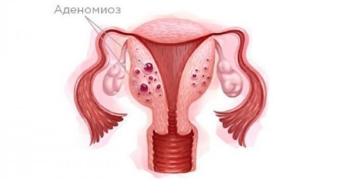 Аденомиоз матки – диффузный и узловой, симптомы и признаки, алгоритм лечения,  народные средства