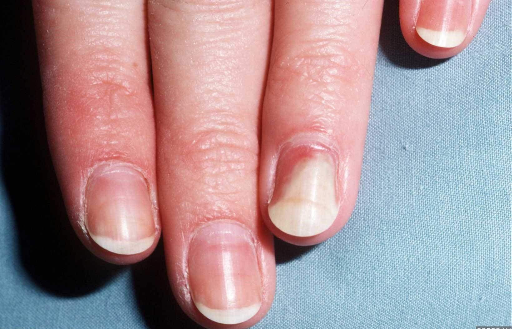 Грибок ногтей и кожи рук: причины появления, лечение