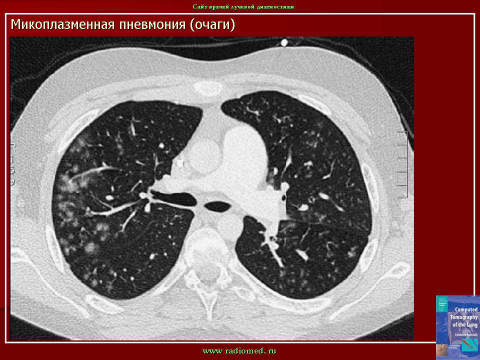 Микоплазма пневмонии — инфекция
