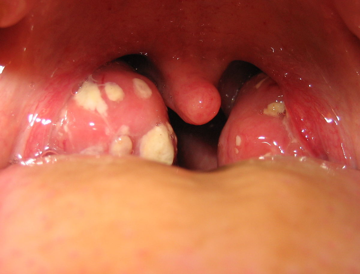 Воспаление миндалин в горле симптомы