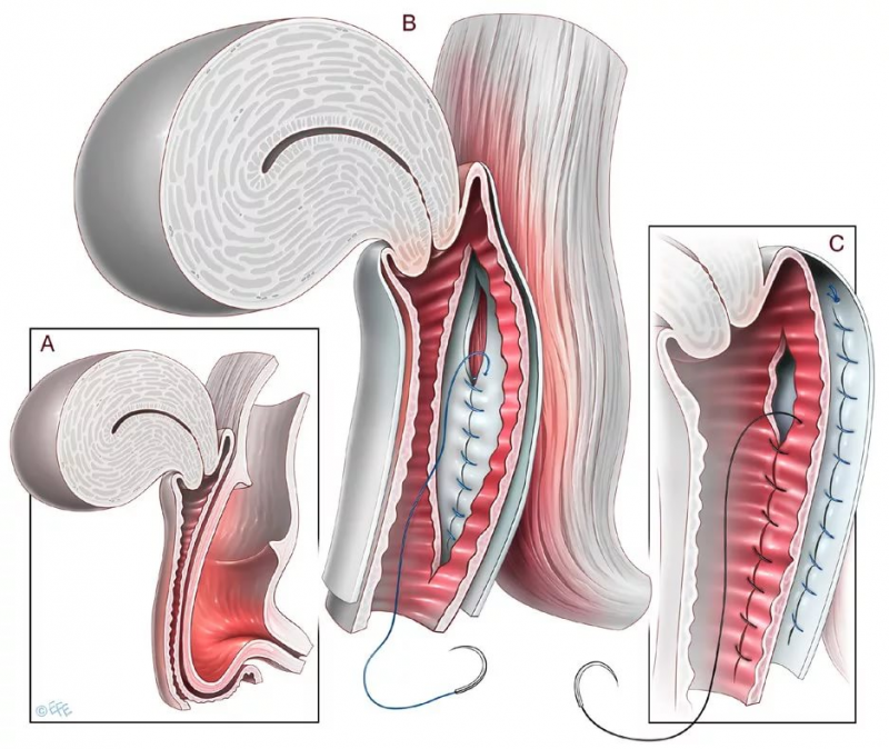 Коррекция опущения половых органов и несостоятельности мышц тазового дна