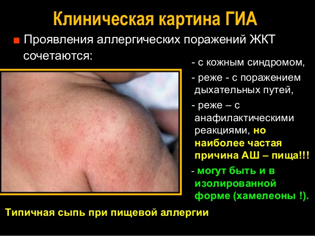 Аллергия хроническое заболевание или нет