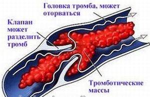 Тромбоэмболия: виды, причины, симптомы артериальной и венозной, лечение