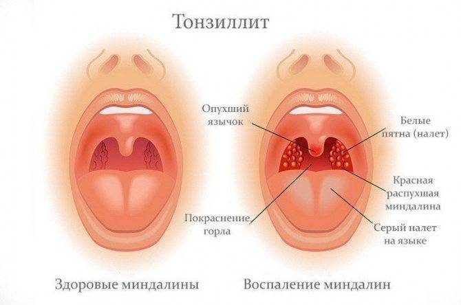 В носоглотке скапливается слизь чем лечить. Смотреть фото В носоглотке скапливается слизь чем лечить. Смотреть картинку В носоглотке скапливается слизь чем лечить. Картинка про В носоглотке скапливается слизь чем лечить. Фото В носоглотке скапливается слизь чем лечить