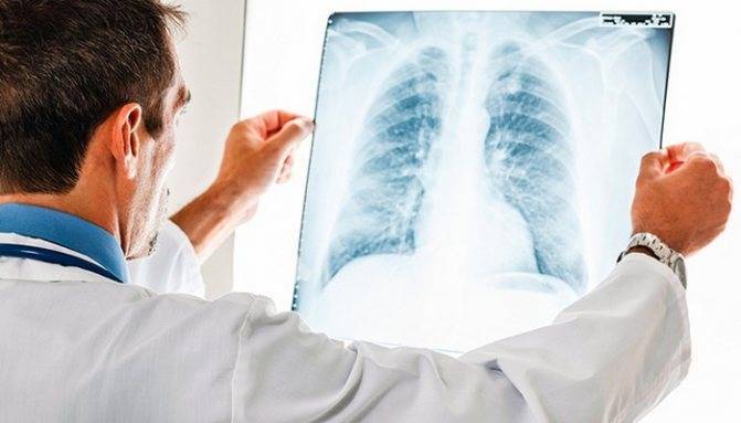 Как вылечить туберкулёз