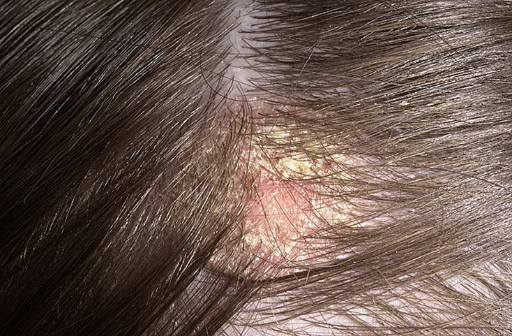 Себорейный дерматит волосистой части головы у детей: лечение