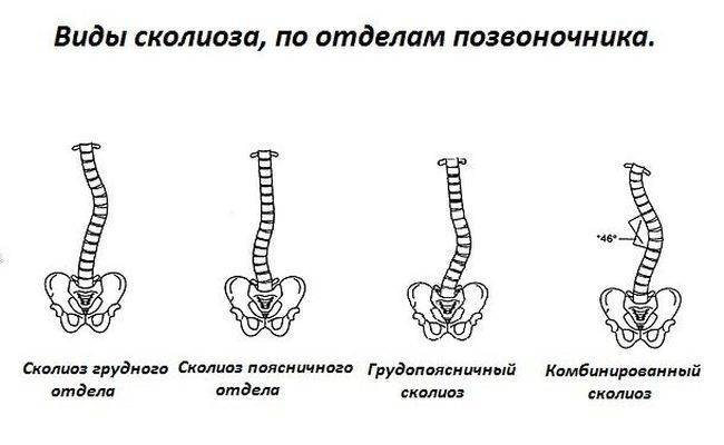 Сколиоз третьей степени фото