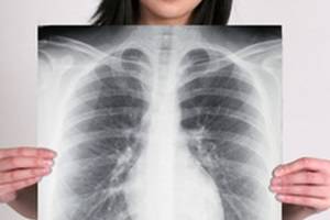 Как проходит пневмония без кашля