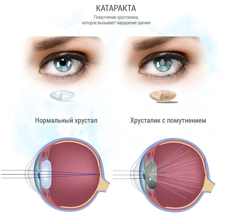Когда после замены хрусталика восстанавливается зрение глаза. Хрусталик глаза. Катаракта глаза симптомы.