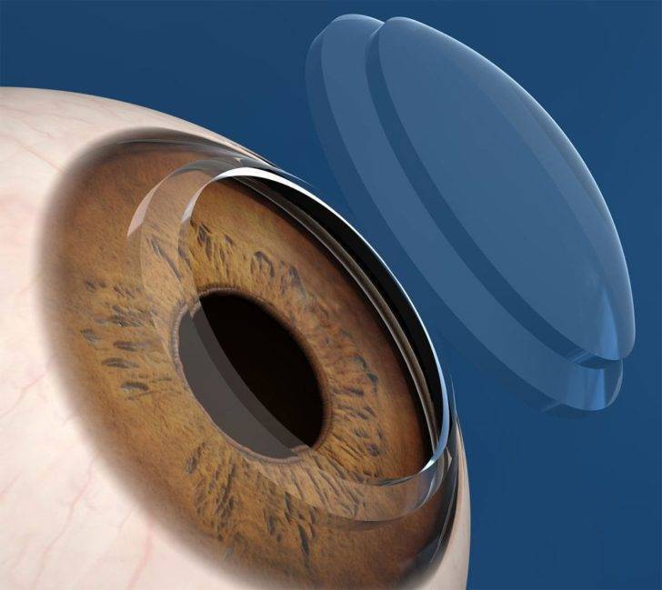 Кератотопография роговицы глаза: показания и результаты