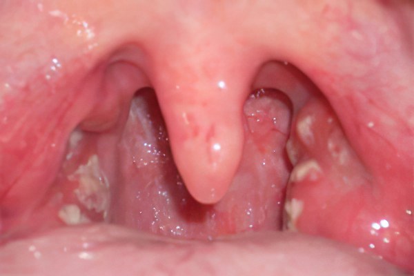 Грибок в горле (кандидоз): как появляется, симптомы, лечение