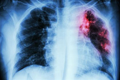 «туберкулез приобрел признаки эпидемии»: о самой смертоносной инфекции