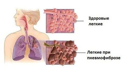 Методика восстановления легких дыхательной гимнастикой после пневмонии