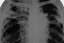 Признаки и способы лечения казеозной пневмонии при туберкулезе