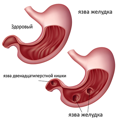 Питание после операции на желудке при прободной язве желудка