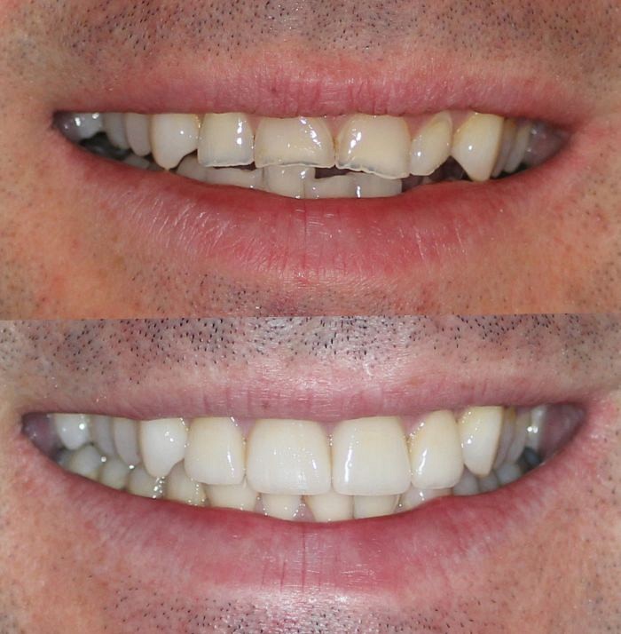 Восстановление зубов — способы реставрации разрушенного зуба, цены, фото