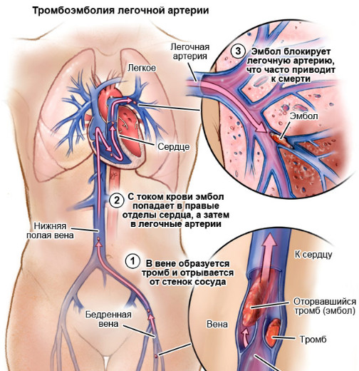 Симптомы и неотложная помощь при тромбоэмболии легочной артерии