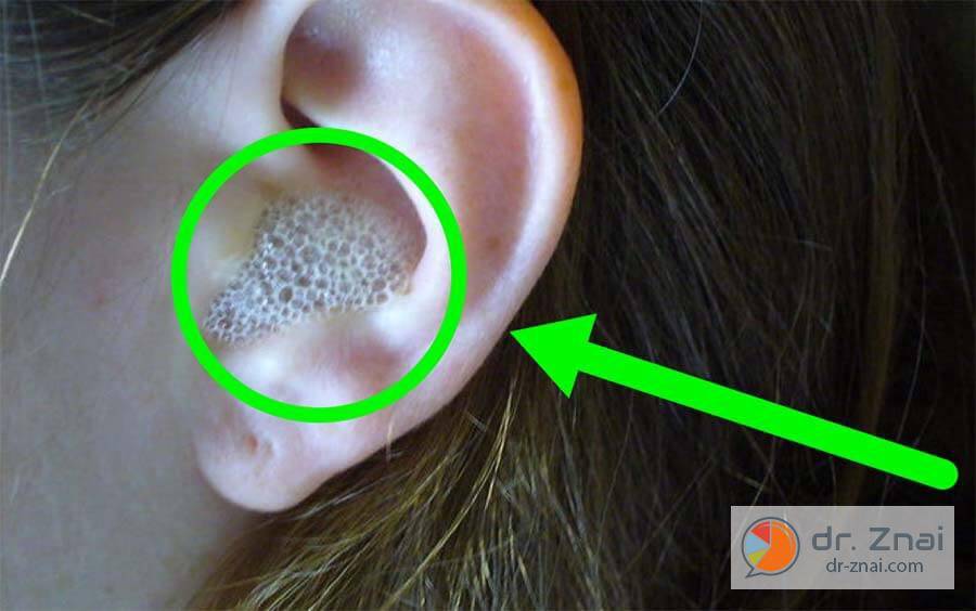 Как правильно промыть ухо от серной пробки в домашних условиях?