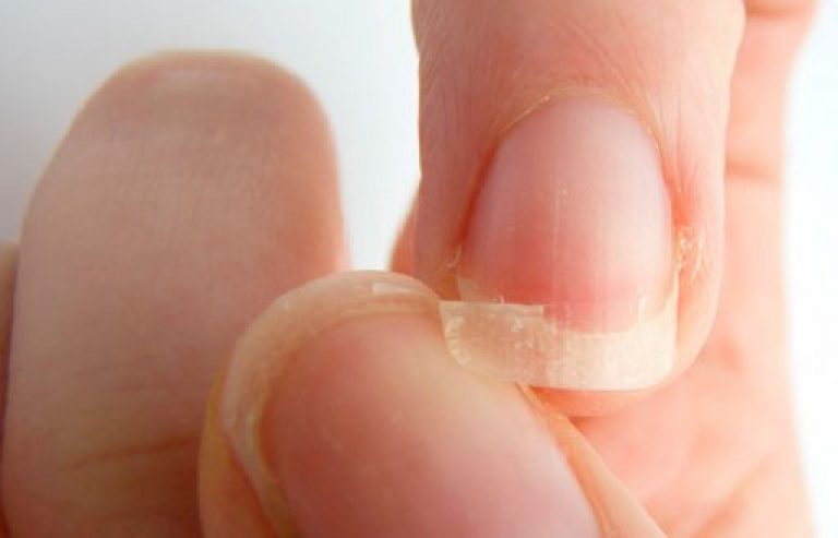 Грибок ногтей и кожи рук: причины появления, лечение
