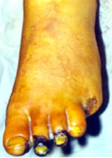 Симптомы и лечение облитерирующего эндартериита сосудов ног