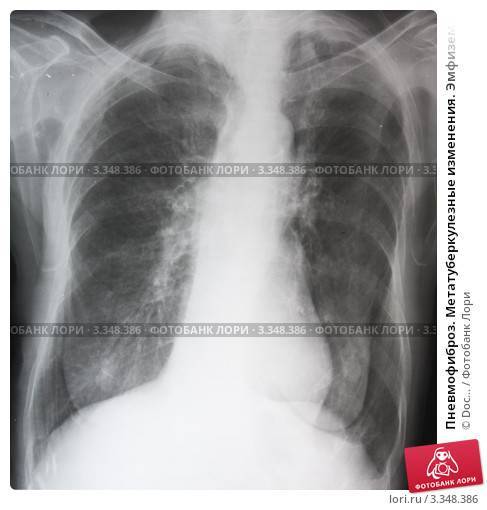 Хронические инфекции: что такое туберкулёз и чем он опасен