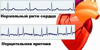 Аритмия сердца – что такое аритмия, нарушение сердечного ритма? аритмия – симптомы, причины, лечение