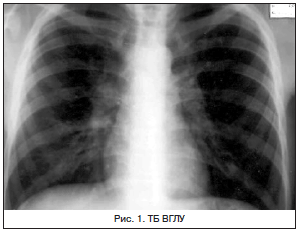 Может ли пневмония перейти в туберкулез?