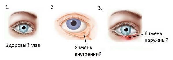 Пингвекула - лечение наростов на глазах