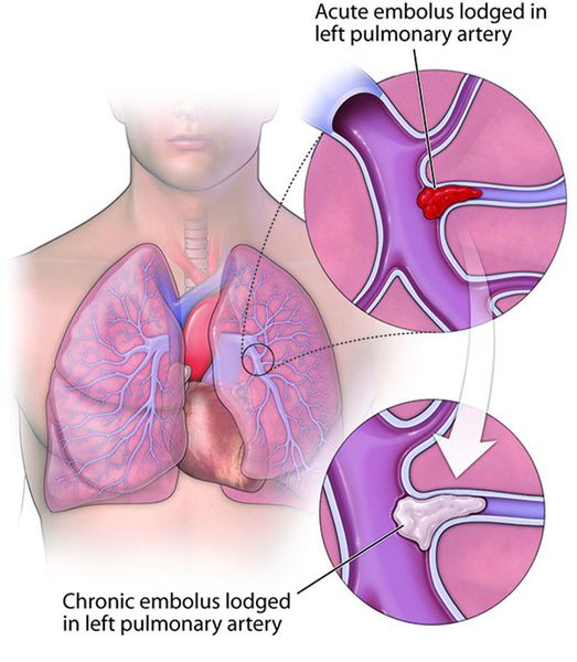 Причины, лечение и прогноз для жизни при тромбоэмболии легочной артерии
