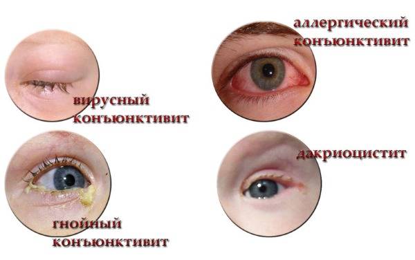 Глазные капли от коньюктивита для детей с антибиотиком