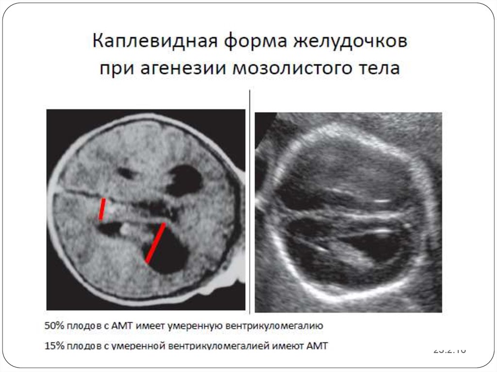 Агенезия мозолистого тела - запись пользователя ольга (nashmalish1) в сообществе здоровье будущей мамы и малыша в категории редкие случаи (малыш) - babyblog.ru