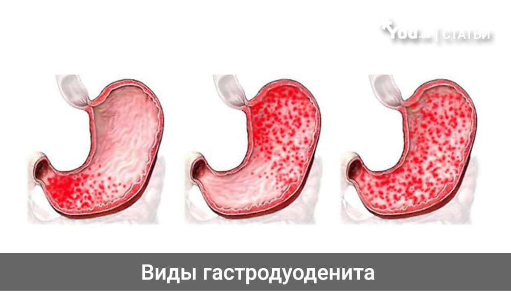 Лечение поверхностного гастродуоденита препараты схема лечения